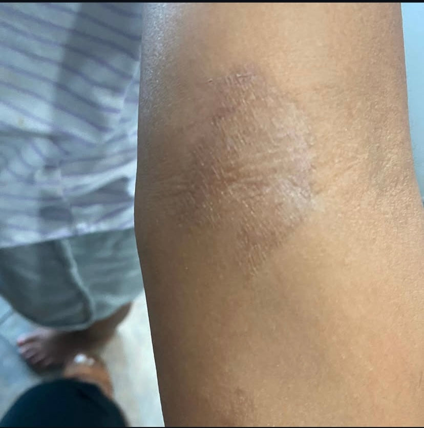 Arm with eczema and dry patches before using rich body butter